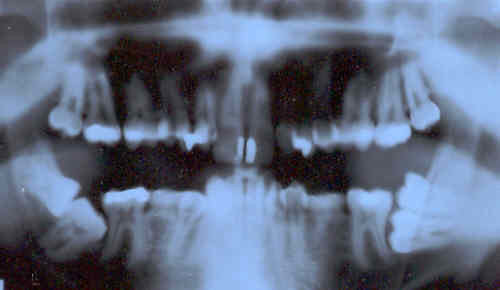 xray image of teeth